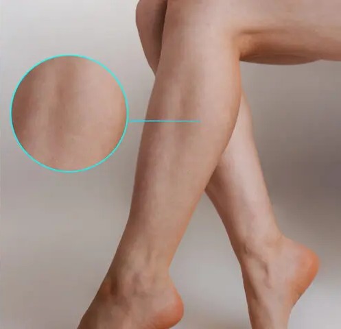 VaricoLift